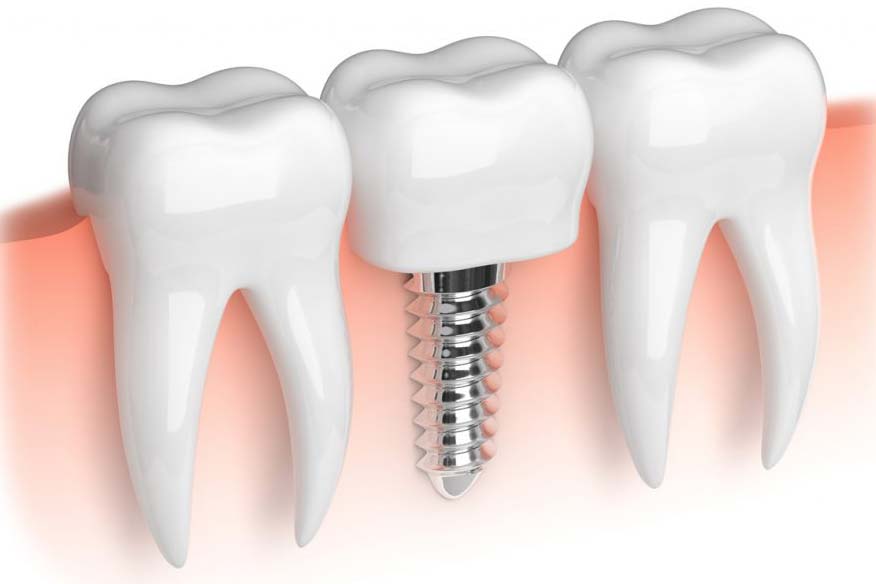 Dental İmplant