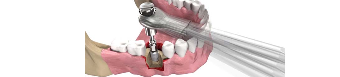 Dental İmplant Nasıl Yapılır