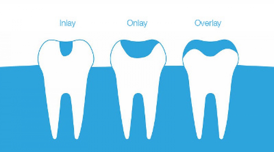inlay - onlay - overlay