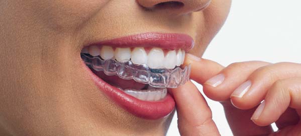 Invisalign