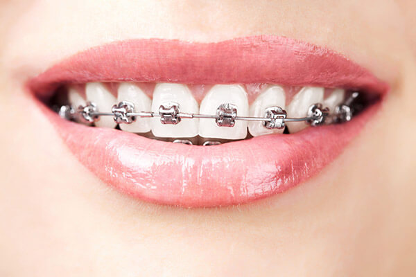 Metal Braket